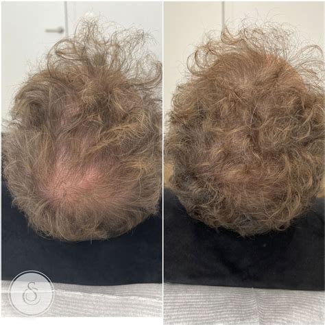 Haartransplantatie En Haarverlies: Wat Te Doen?