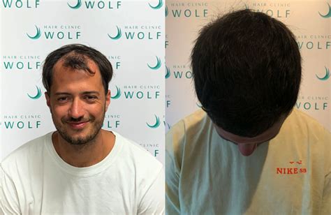 Haartransplantatie Saffier FUE: Wat Is Het?